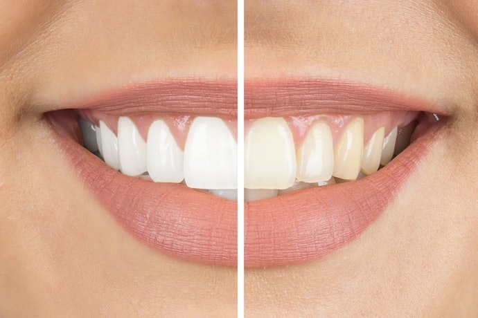 ขั้นแรก เช็กความแตกต่างของคุณสมบัติที่ทำให้ฟันขาวของน้ำยาบ้วนปาก ฟันขาว 